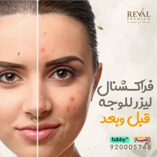 تجربتي مع فراكشنال ليزر للوجه
