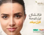 فراكشنال ليزر للوجه قبل وبعد: أسرار ونصائح الفراكشنال لنتائج أفضل بالرياض