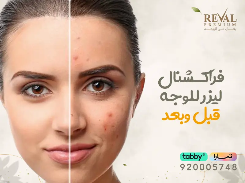 فراكشنال ليزر للوجه قبل وبعد: أسرار ونصائح الفراكشنال لنتائج أفضل بالرياض