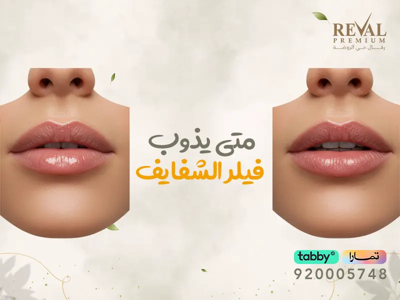 متى يذوب فيلر الشفايف؟ نصائح لنتائج تدوم أطول