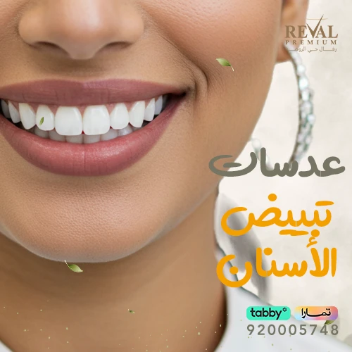 كيف تختار أفضل أنواع عدسات تبييض الأسنان- تجربتي مع عدسات تبييض الأسنان