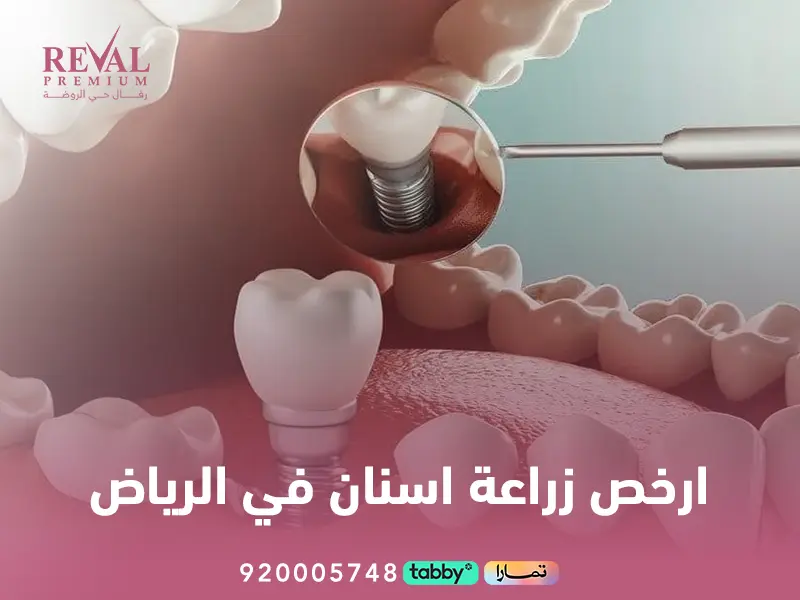 ارخص زراعة اسنان في الرياض: دليلك المتكامل لاختيار أفضل العيادات والأسعار