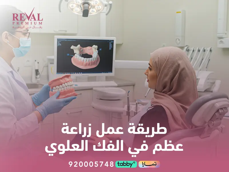طريقة عمل زراعة عظم في الفك العلوي بالرياض