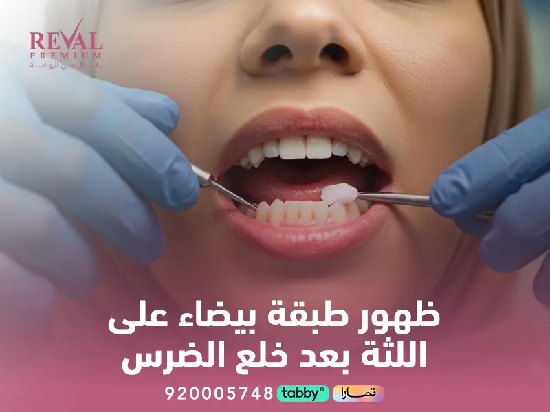 ظهور طبقة بيضاء على اللثة بعد خلع الضرس