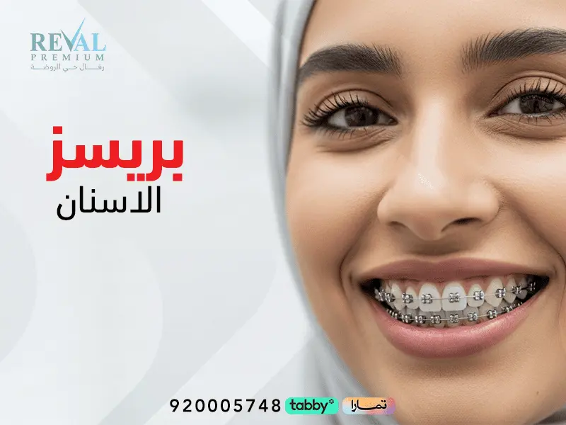 بريسز الأسنان (Braces): افضل انواع تقويم الاسنان و ألوان بريسز حلوة 2026/2027