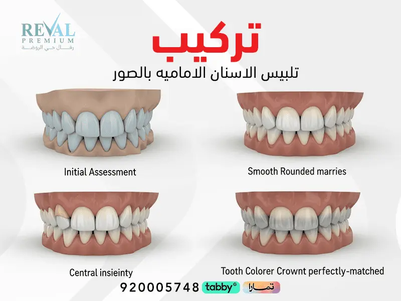 تركيب تلبيس الأسنان الأمامية بالصور – متى أقدر أن آكل بعد تلبيس الأسنان؟