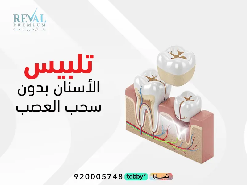 تجربتي مع تلبيس الأسنان