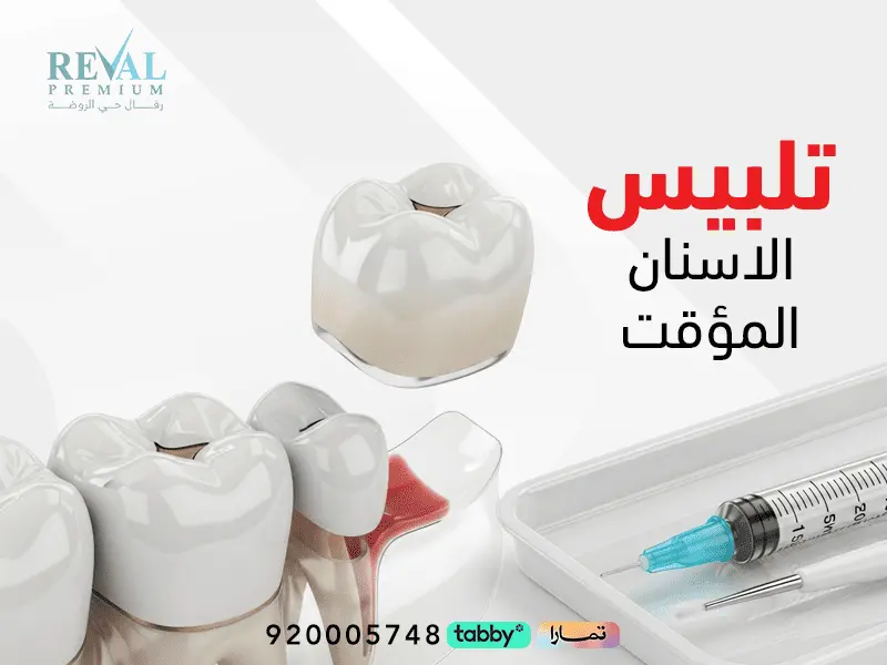 تلبيس الأسنان المؤقت: أنواع وخطوات مميزات وعيوب وكم تدوم التلبيسة المؤقتة؟
