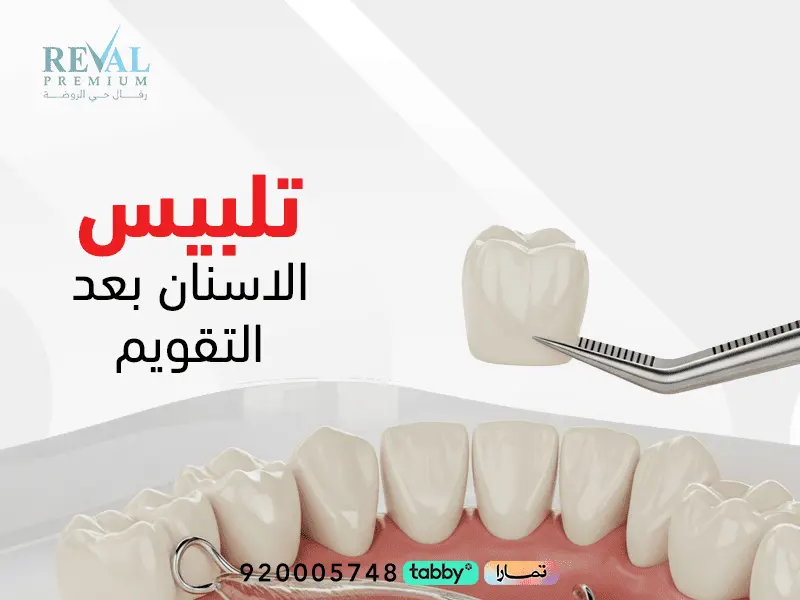 تجربتي مع مثبت التقويم-تلبيس الاسنان بعد التقويم