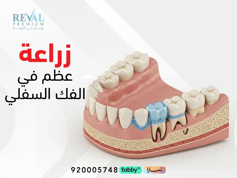 زراعة عظم في الفك السفلي – ما هي نسبة نجاح زراعة عظم الفك؟