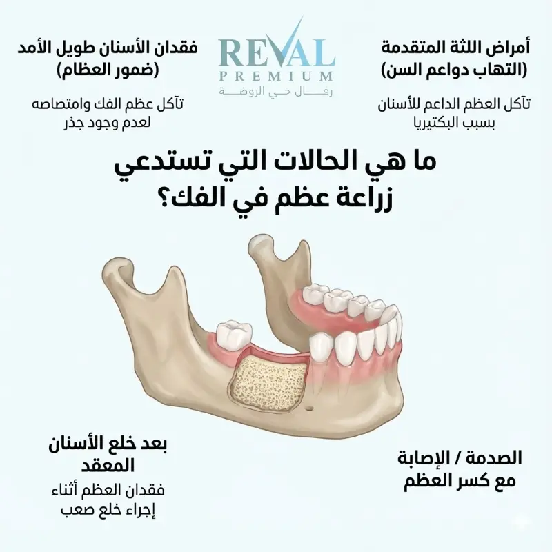 ما هي الحالات التي تستدعي زراعة عظم في الفك؟ تجربتي في عملية زراعة عظم الفك