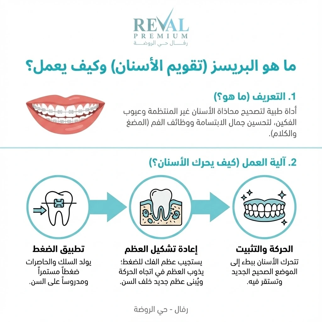 ما هو البريسز؟