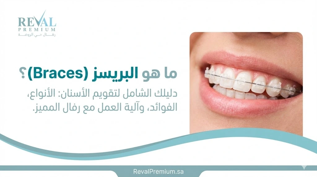 ما هو البريسز؟ دليل شامل لتقويم الأسنان وأنواعه واستخداماته